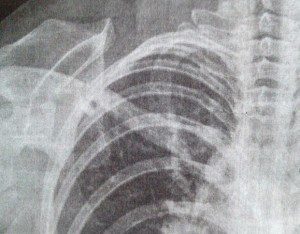 x-ray picture of collarbone